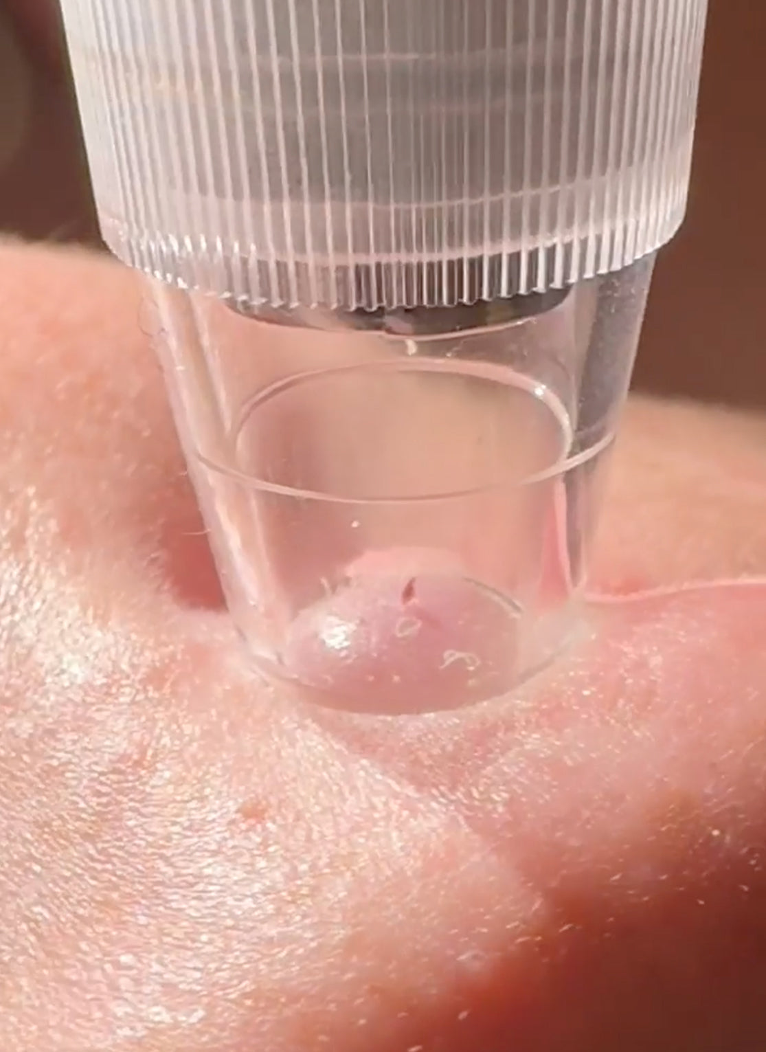 NixPorema Blackhead Remover