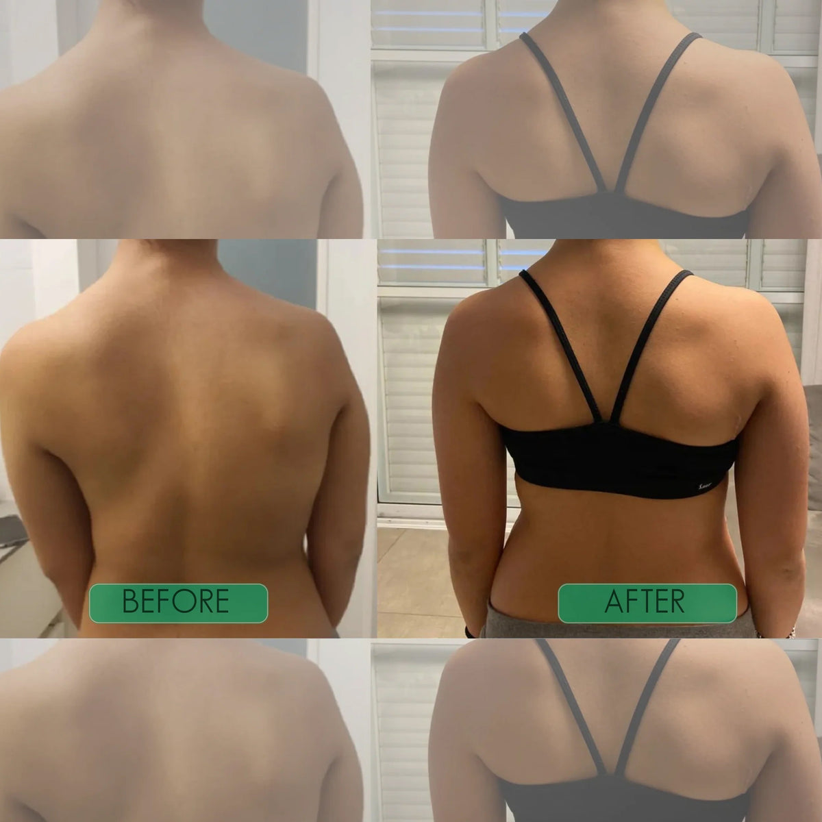 Postrixmer Posture Corrector For Scoliosis