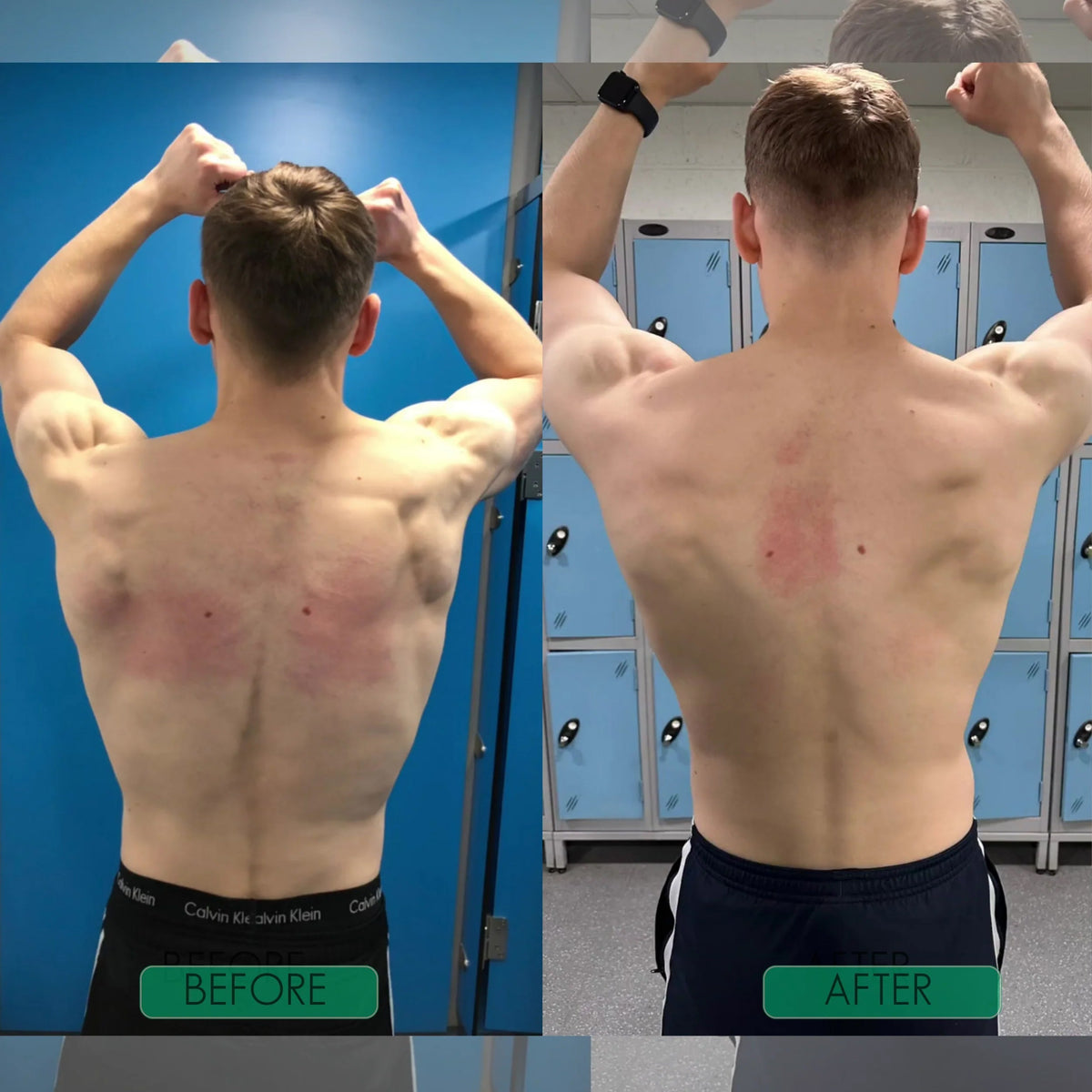 Postrixmer Posture Corrector For Scoliosis