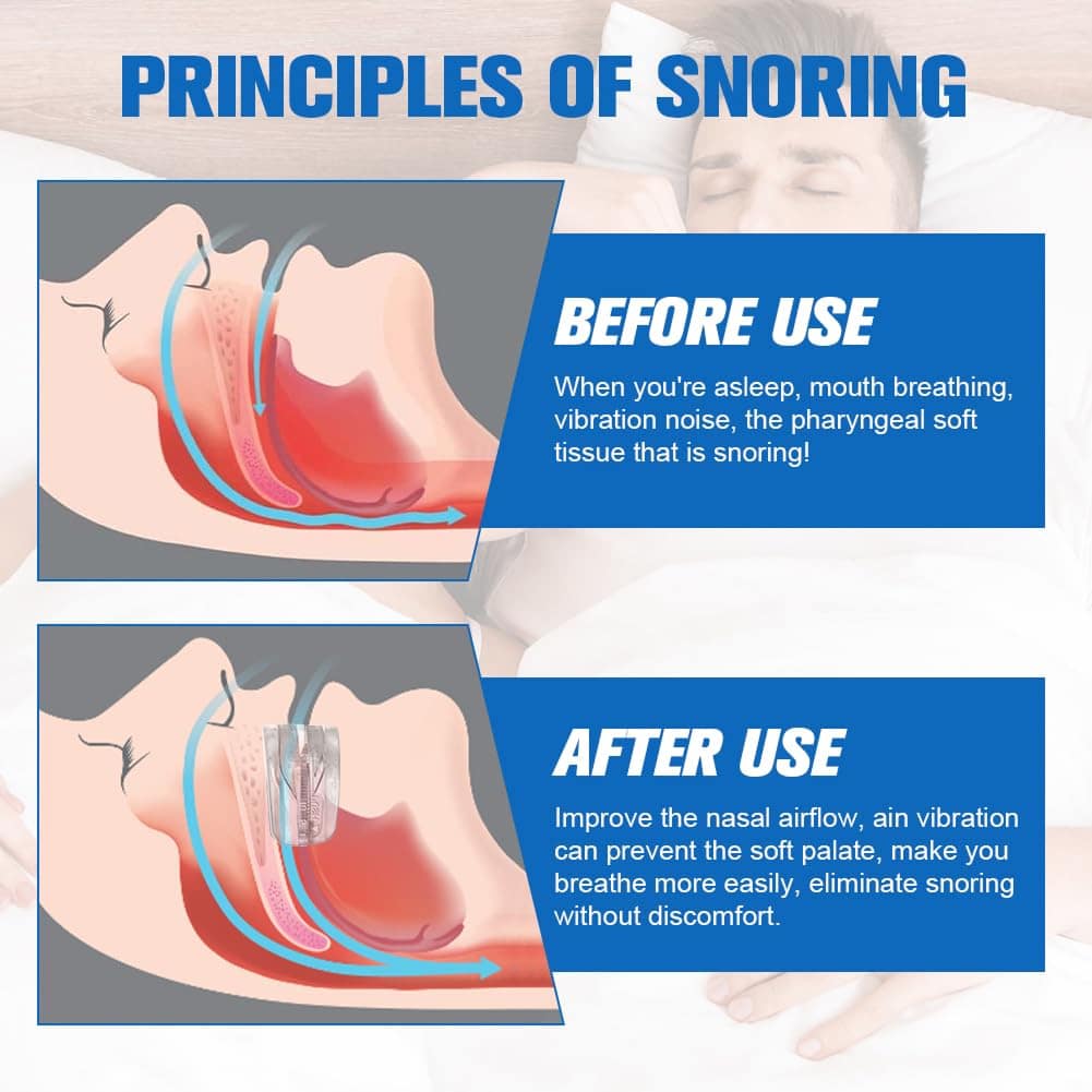 Quietmex Night Guard for Bruxism