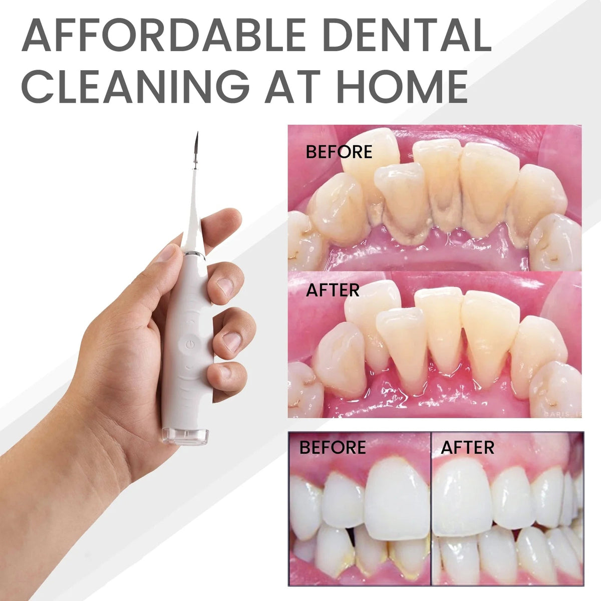 Zamoxque Plaque Remover
